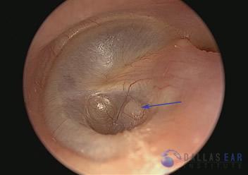 pic-eardrum-retraction