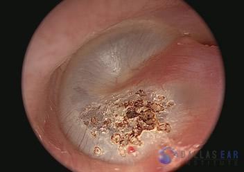 pic-eardrum-retraction2