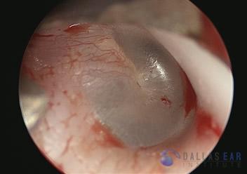 pic-temporal-bone1