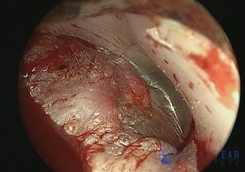 pic-temporal-bone10