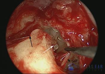 pic-temporal-bone2