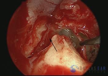 pic-temporal-bone3