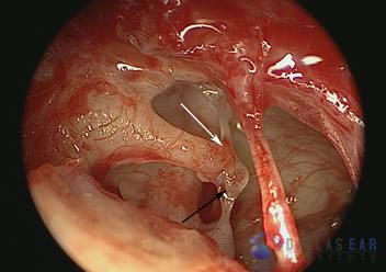 pic-temporal-bone4