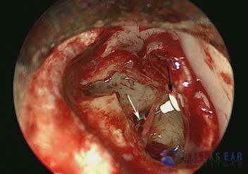pic-temporal-bone6