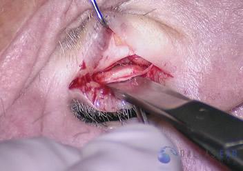 pic-temporal-bone7