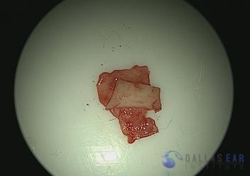 pic-temporal-bone8