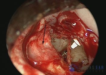 pic-temporal-bone9