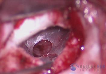 pic-tympanoplasty-central-perforation