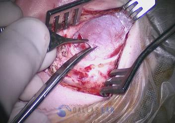 pic-tympanoplasty-fascia-harvest