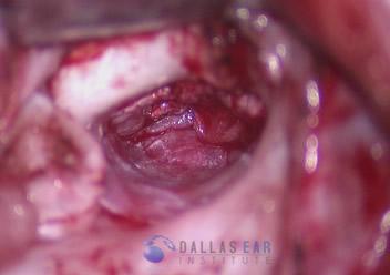 pic-tympanoplasty-fascia-placement