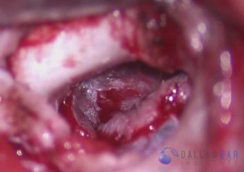 pic-tympanoplasty-final-result