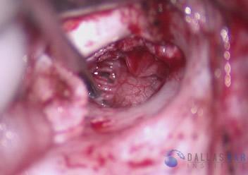 pic-tympanoplasty-tm-reflected