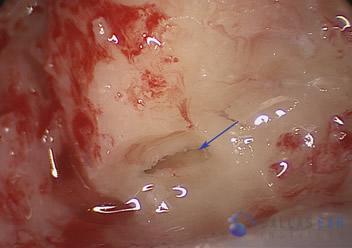 posterior-semicircular-cases3