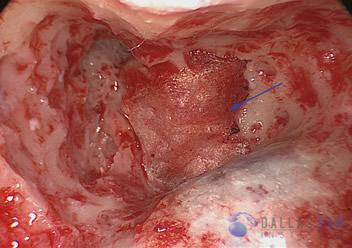 posterior-semicircular-cases6
