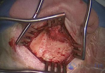 superior-semicircular-canal-dehiscence1
