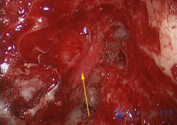 superior-semicircular-canal-dehiscence10