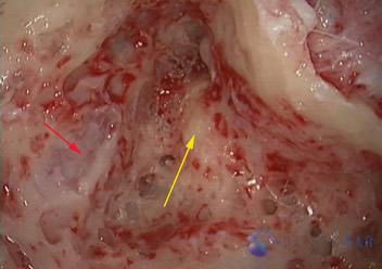 superior-semicircular-canal-dehiscence2