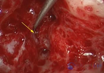 superior-semicircular-canal-dehiscence3