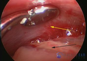 superior-semicircular-canal-dehiscence4