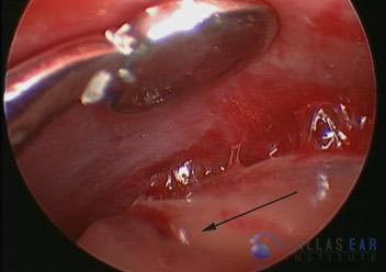 superior-semicircular-canal-dehiscence5