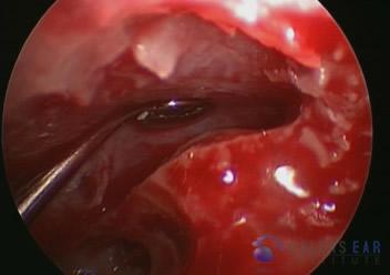 superior-semicircular-canal-dehiscence6