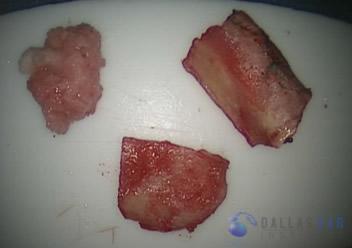 superior-semicircular-canal-dehiscence7