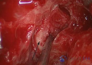 superior-semicircular-canal-dehiscence8
