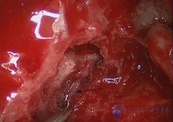 superior-semicircular-canal-dehiscence9