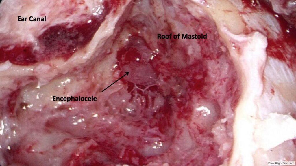 Ear Canal