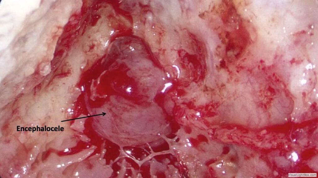 Encephalocele