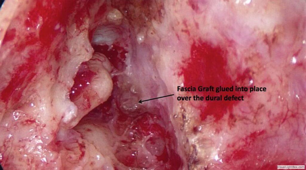 Fascia Graft