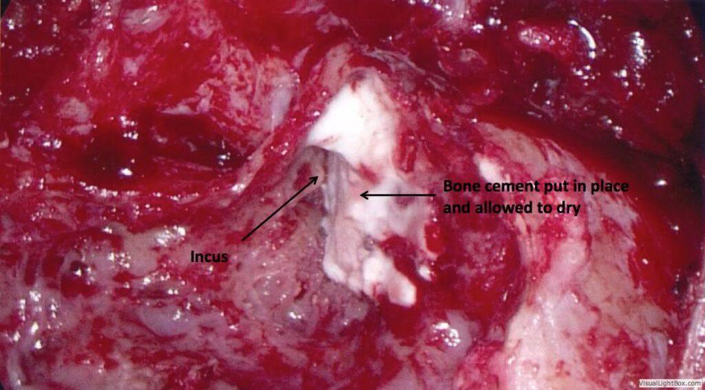 Incus Bone Cement