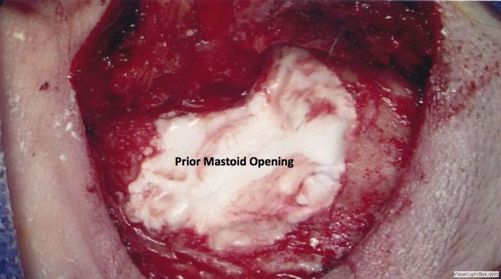 Prior Mastoid Opening