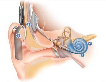 Diagram of how a cochlear implant works