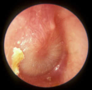 image of inner ear infection.