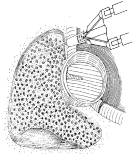 Bone Paste.