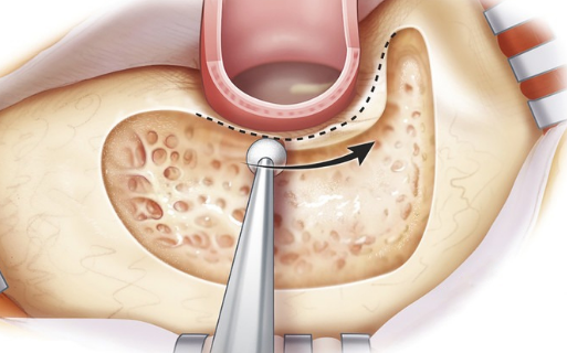 Cortical Mastoidectomy.