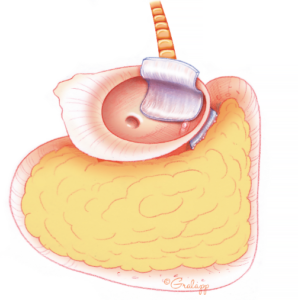 Mastoid and Eustachian Tube Obliteration.