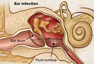 Ear with fluid in them.